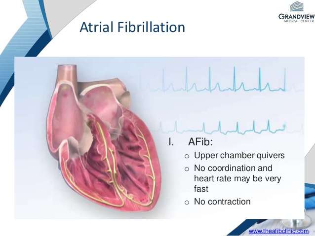 Afib and How It Affects Your Heart Rate