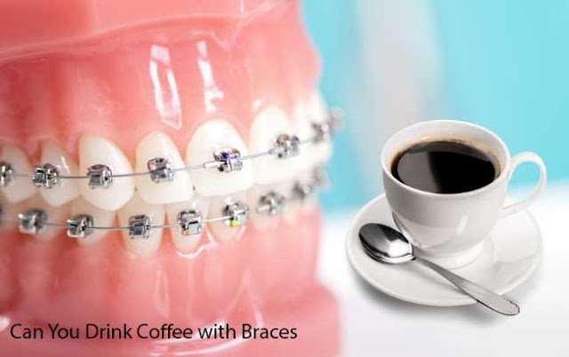 Can You Drink Coffee with Braces and Iced Tea