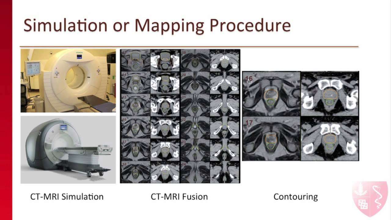 Stanford Radiation Oncologist Explains Radiation Therapy ...