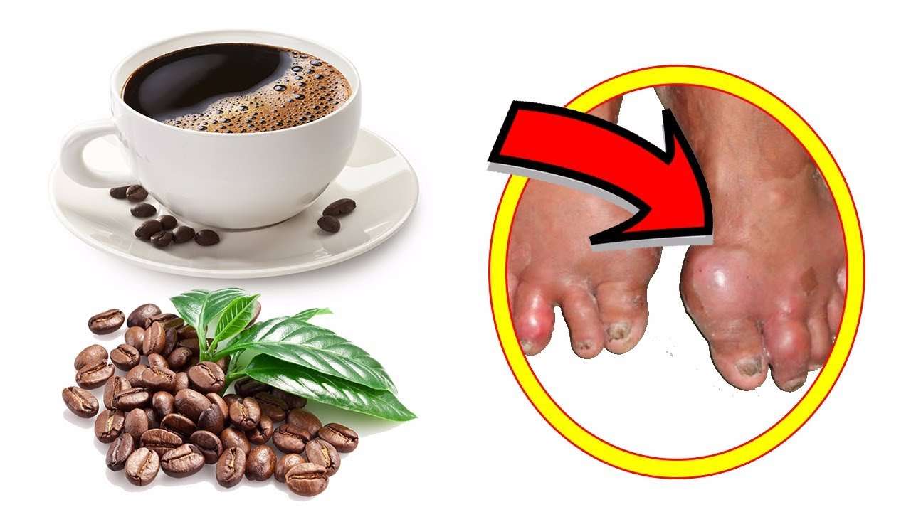 The Bitter Truth: Coffee Causes Gout Attacks