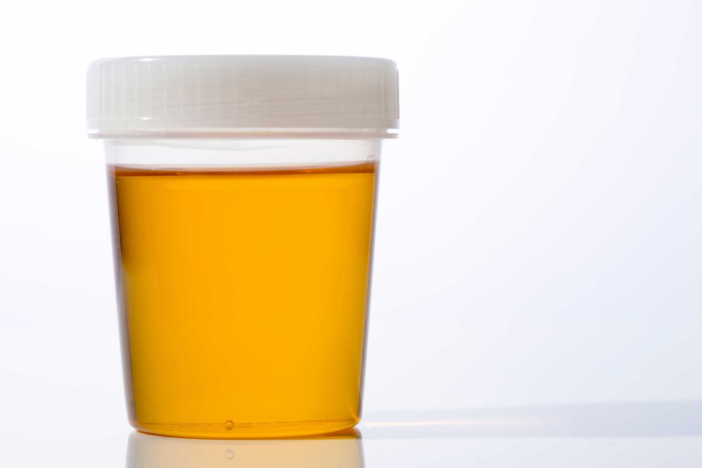 Urine Infections, Urine Color: What Urine Says About ...